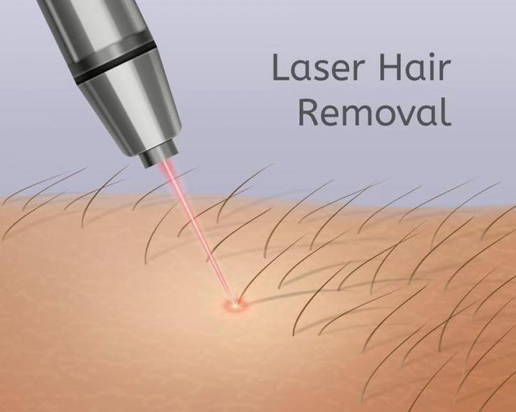 laser hair removal machine types